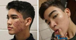 remaja laki-laki menggunakan skincare untuk menghilangkan jerawat dan bekasnya untuk remaja - TribunLiputan